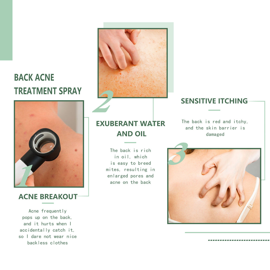 Jaysuing Back Acne Repair Spray, Repair Body Acne Fade Acne Mark Skin Care Spray